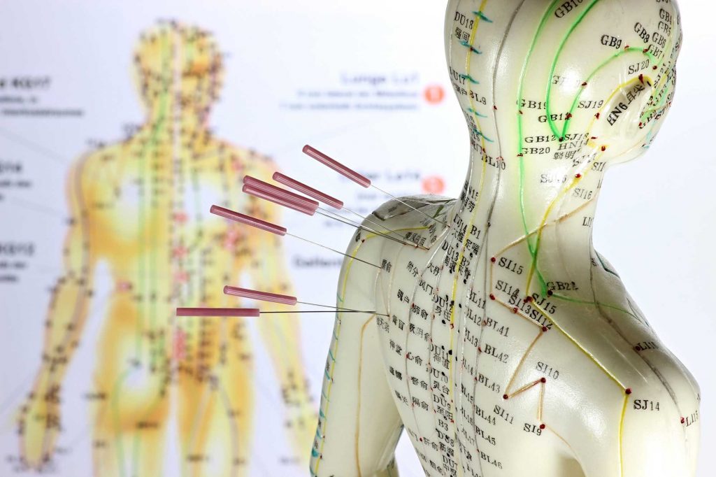 Acupuncture Treatments | K.C Wong Acupuncture , Gillingham, Kent